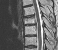 Thoracic Disc MRI